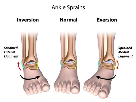 A sprained ankle can create a lot of spiritual confusion for the person who has it. . Sprained left ankle spiritual meaning